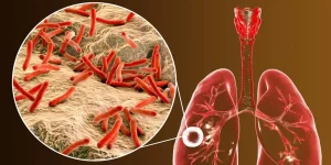 نحوه تشخیص بیماری سل